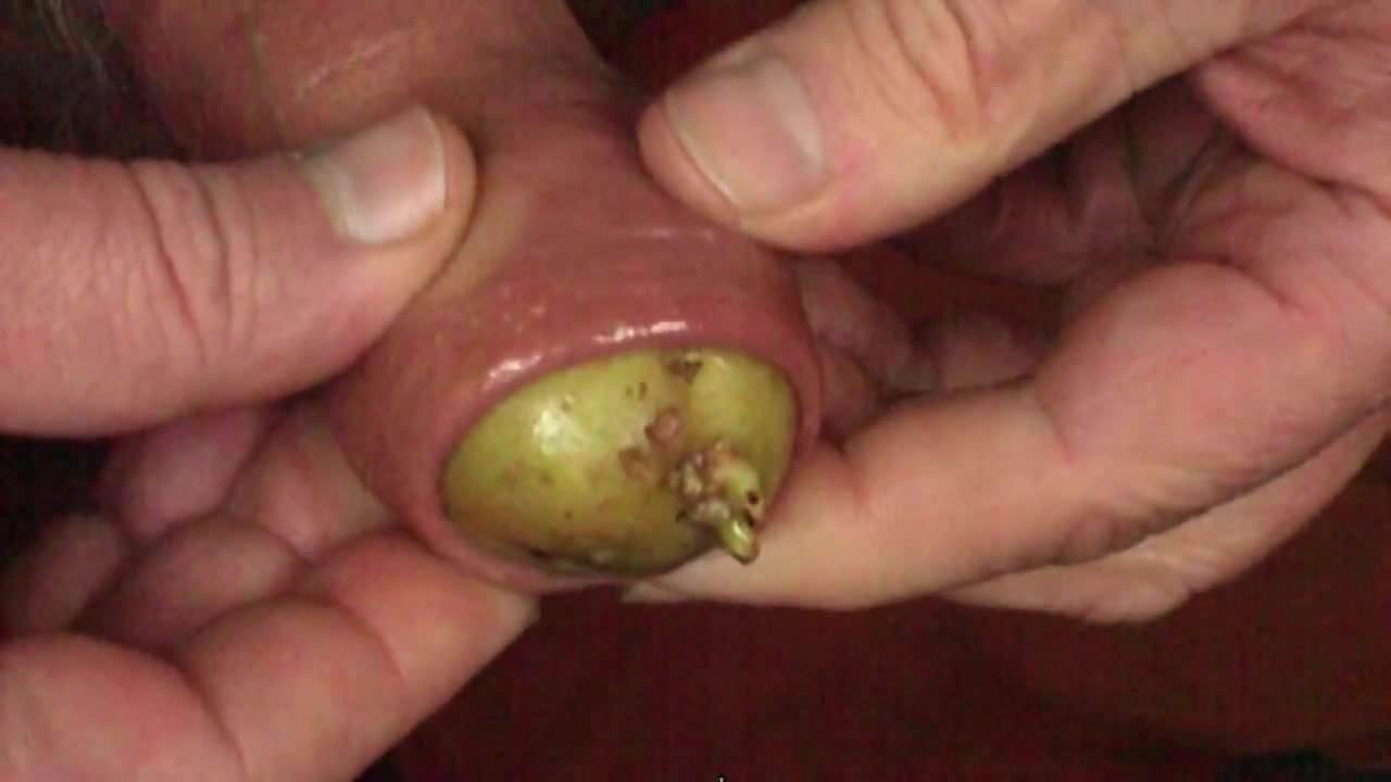 Mr. Potato foreskin - part 2 